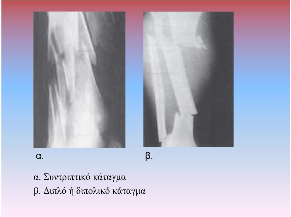 κάταγµα β.