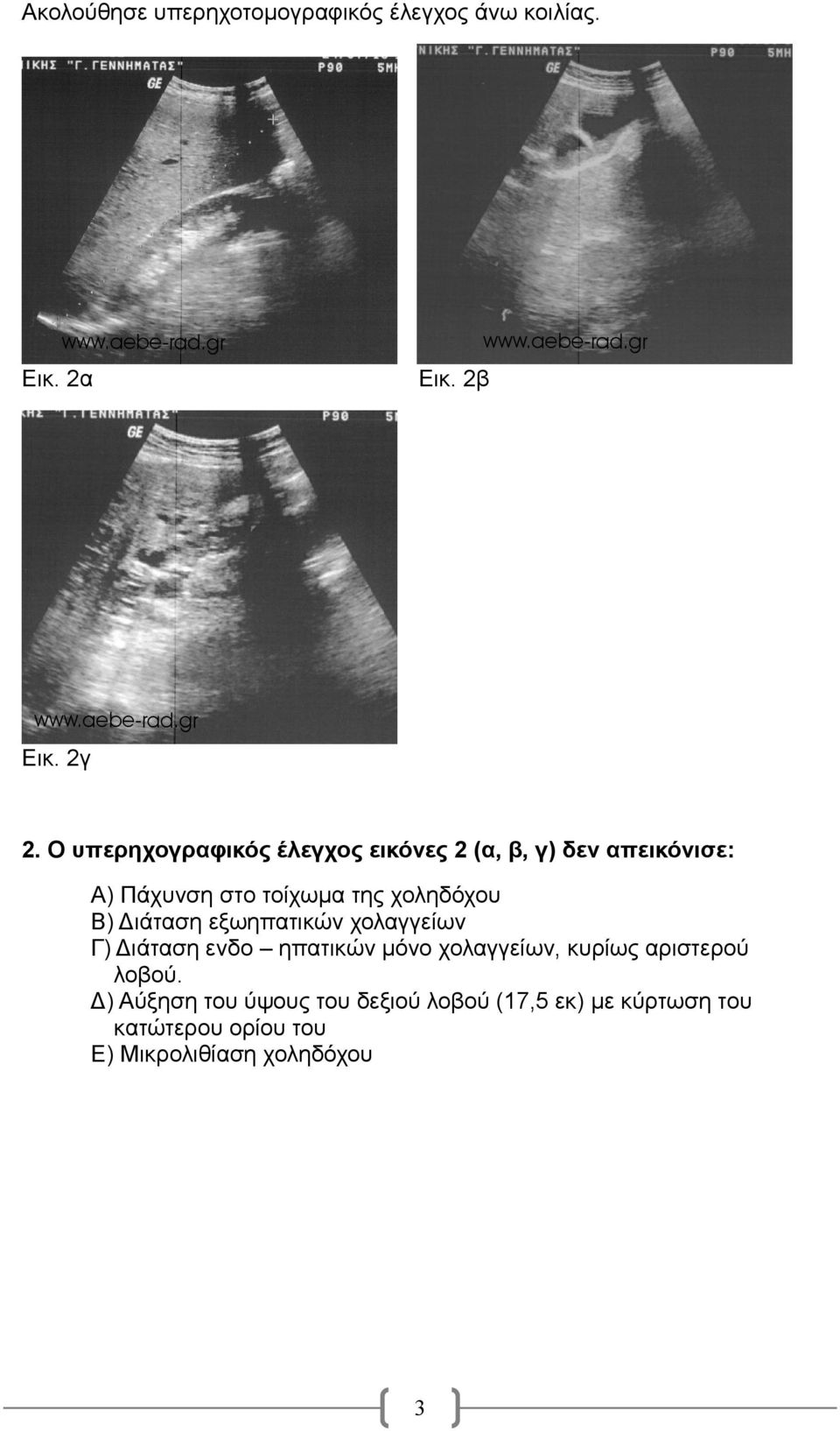 χοληδόχου Β) Διάταση εξωηπατικών χολαγγείων Γ) Διάταση ενδο ηπατικών μόνο χολαγγείων, κυρίως