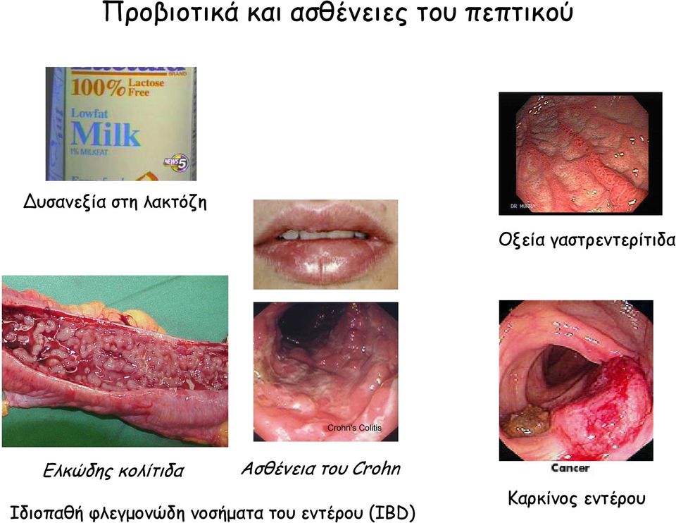 Ελκώδης κολίτιδα Ασθένεια του Crohn Ιδιοπαθή