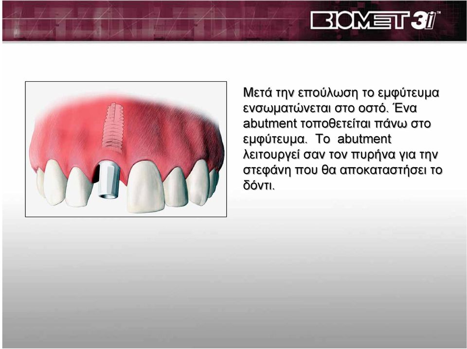 Ένα abutment τοποθετείται πάνω στο εμφύτευμα.