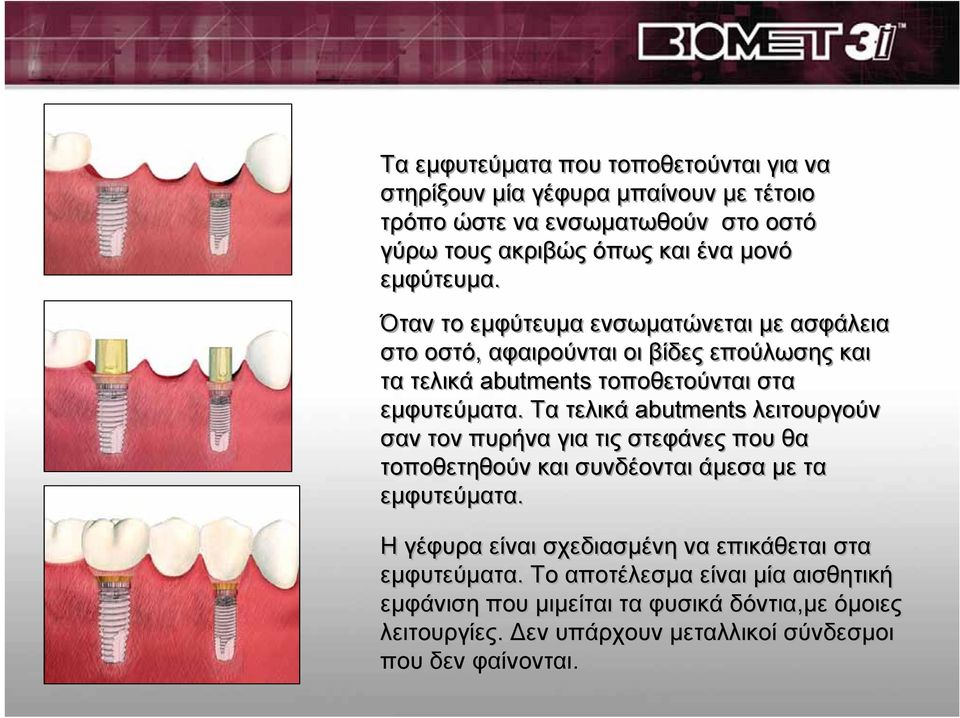 Tα τελικάabutments λειτουργούν σαν τον πυρήνα για τις στεφάνες που θα τοποθετηθούν και συνδέονται άμεσα με τα εμφυτεύματα.