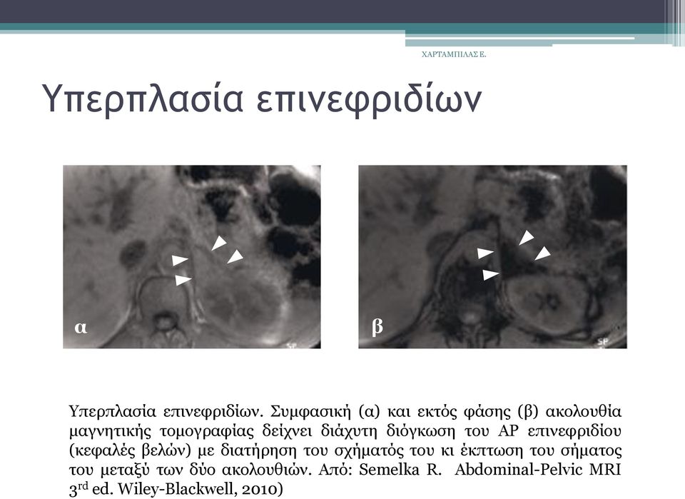δηφγθσζε ηνπ ΑΡ επηλεθξηδίνπ (θεθαιέο βειψλ) κε δηαηήξεζε ηνπ ζρήκαηφο ηνπ θη