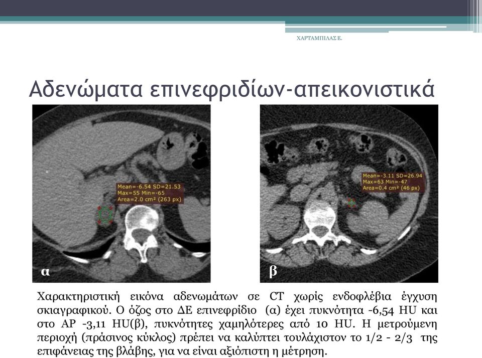Ο φδνο ζην ΔΕ επηλεθξίδην (α) έρεη ππθλφηεηα -6,54 HU θαη ζην AΡ -3,11 HU(β), ππθλφηεηεο