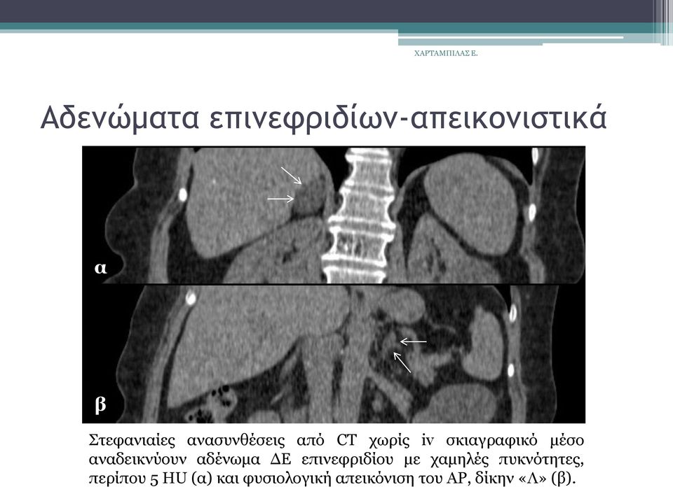 αλαδεηθλχνπλ αδέλσκα ΔΕ επηλεθξηδίνπ κε ρακειέο