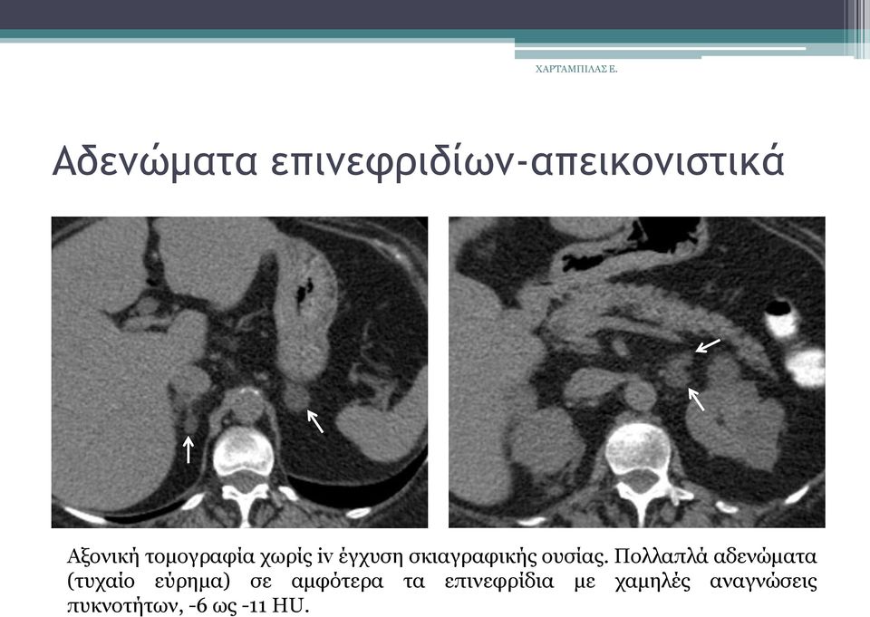 Πνιιαπιά αδελψκαηα (ηπραίν εχξεκα) ζε ακθφηεξα ηα