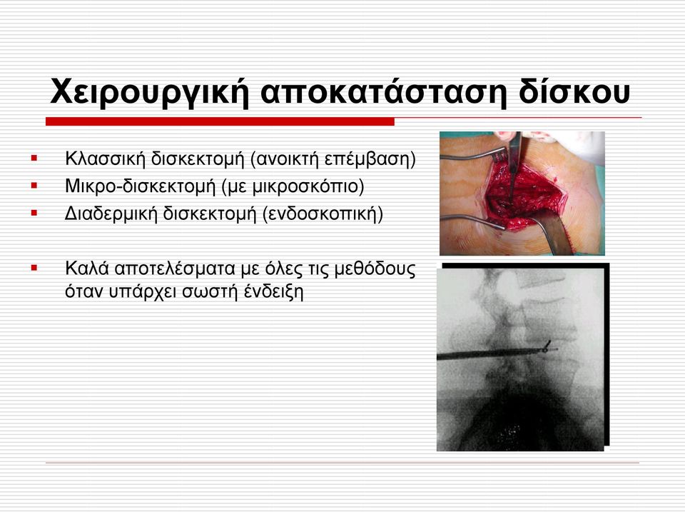 κηθξνζθόπην) Γηαδεξκηθή δηζθεθηνκή (ελδνζθνπηθή)