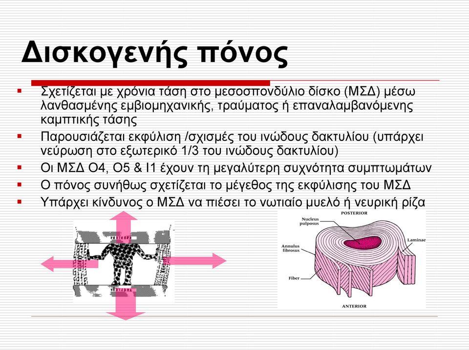 λεύξσζε ζην εμσηεξηθό 1/3 ηνπ ηλώδνπο δαθηπιίνπ) Οη ΜΓ Ο4, Ο5 & Η1 έρνπλ ηε κεγαιύηεξε ζπρλόηεηα ζπκπησκάησλ Ο