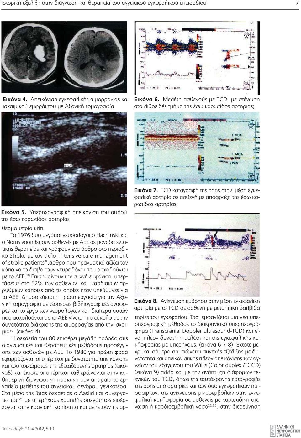 ΤCD καταγραφή της ροής στην μέση εγκεφαλική αρτηρία σε ασθενή με απόφραξη της έσω καρωτίδος αρτηρίας; Εικόνα 8.