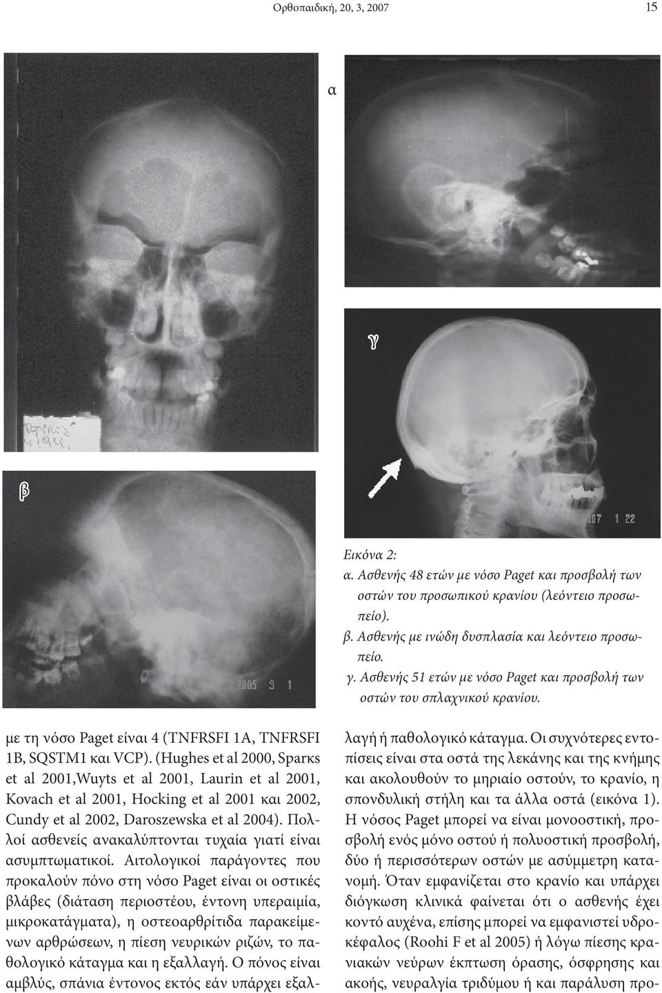 (Hughes et al 2000, Sparκs et al 2001,Wuyts et al 2001, Laurin et al 2001, Kovach et al 2001, Hocking et al 2001 και 2002, Cundy et al 2002, Daroszewska et al 2004).