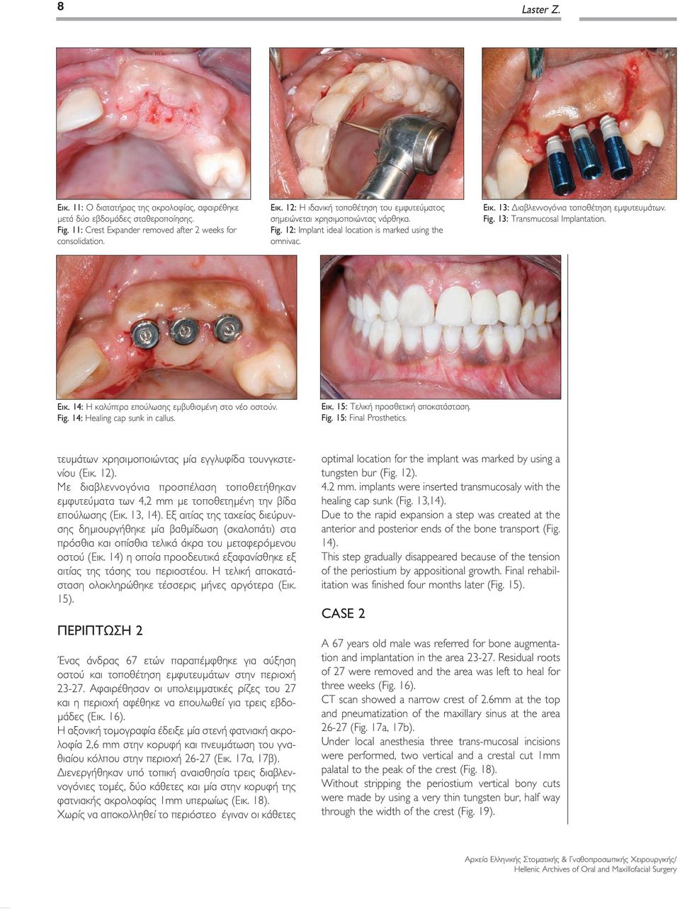 Fig. 14: Healing cap sunk in callus. Εικ. 15: Τελική προσθετική αποκατάσταση. Fig. 15: Final Prosthetics. τευμάτων χρησιμοποιώντας μία εγγλυφίδα τουνγκστενίου (Εικ. 12).