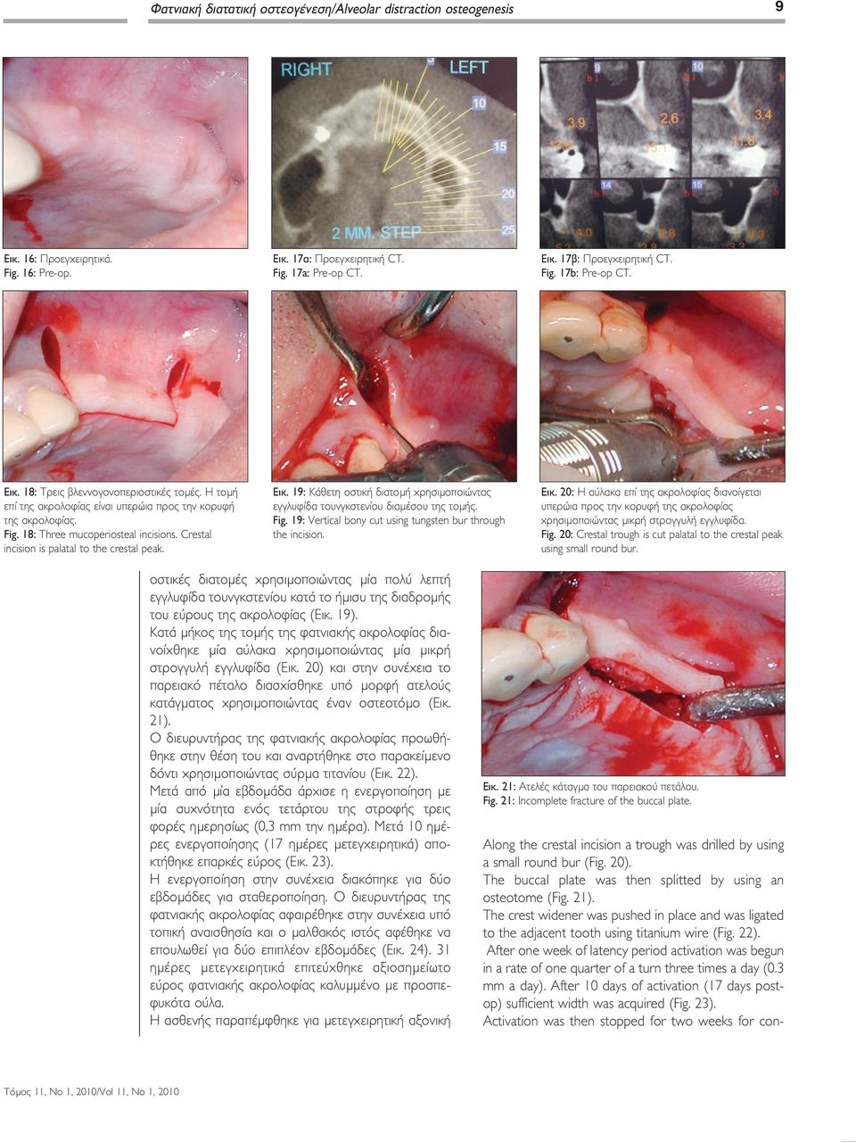 Crestal incision is palatal to the crestal peak. Εικ. 19: Κάθετη οστική διατομή χρησιμοποιώντας εγγλυφίδα τουνγκστενίου διαμέσου της τομής. Fig.