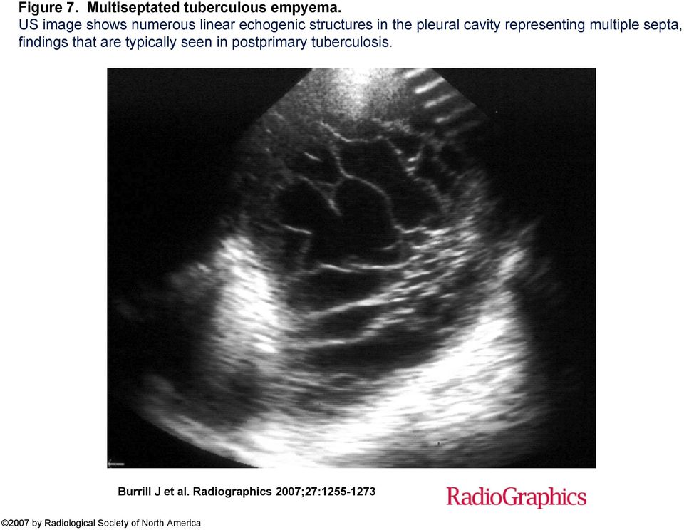 representing multiple septa, findings that are typically seen in