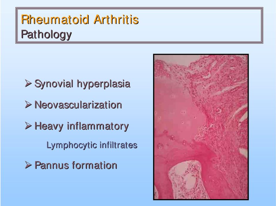 Neovascularization Heavy