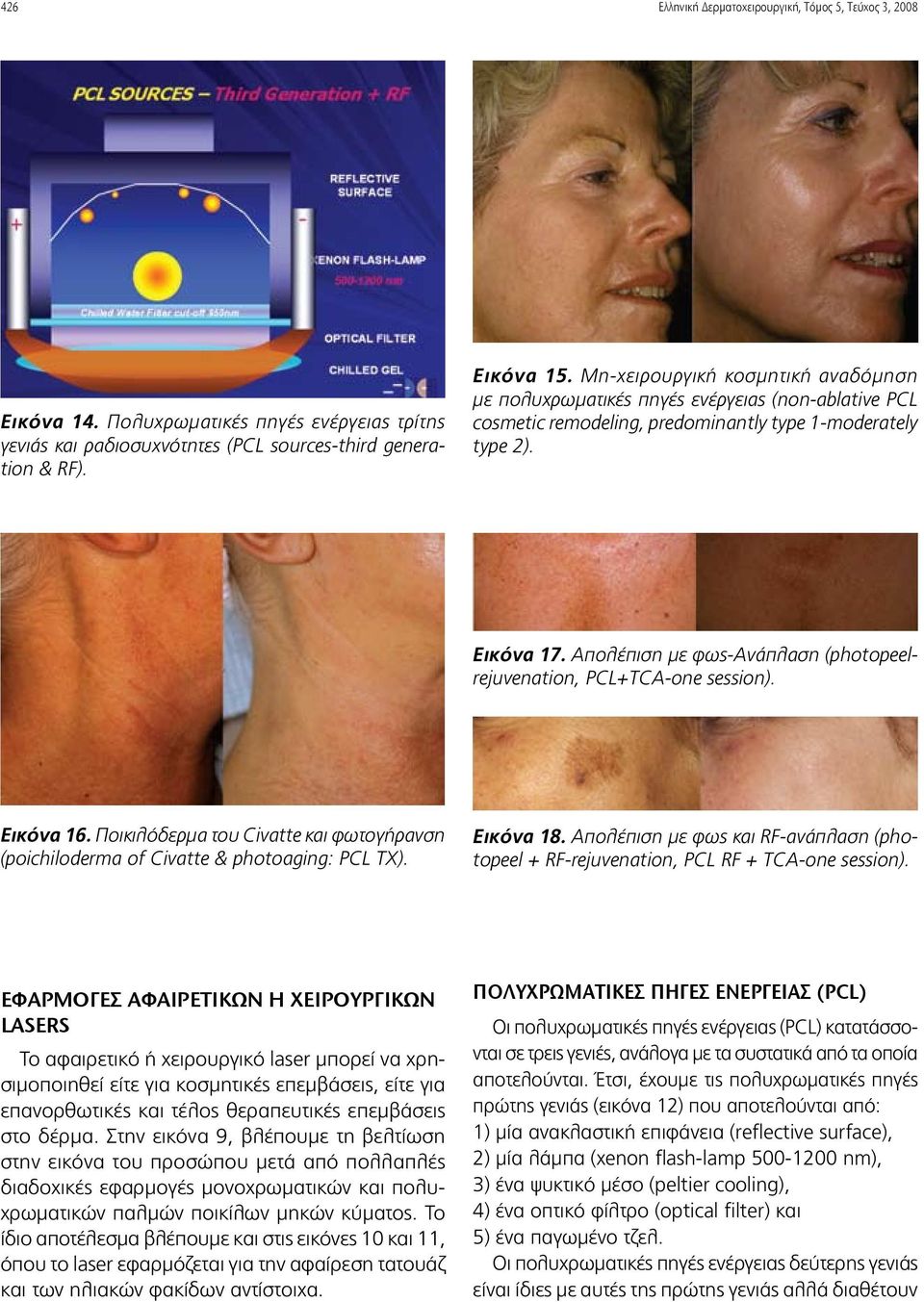 Απολέπιση με φως-ανάπλαση (photopeelrejuvenation, PCL+TCΑ-one session). Εικόνα 16. Ποικιλόδερμα του Civatte και φωτογήρανση (poichiloderma of Civatte & photoaging: PCL TX). Εικόνα 18.