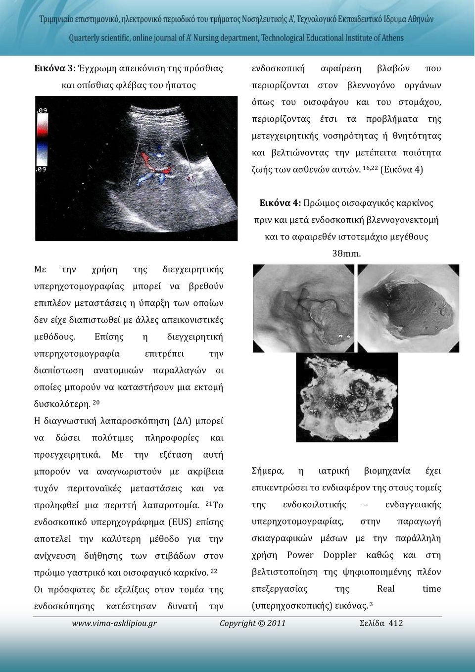 16,22 (Εικόνα 4) Εικόνα 4: Πρώιμος οισοφαγικός καρκίνος πριν και μετά ενδοσκοπική βλεννογονεκτομή και το αφαιρεθέν ιστοτεμάχιο μεγέθους 38mm.