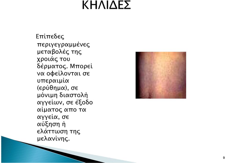 Μπορεί να οφείλονται σε υπεραιµία (ερύθηµα), σε