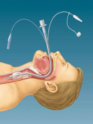 drainage accumulation CDC Guideline for Prevention of Healthcare