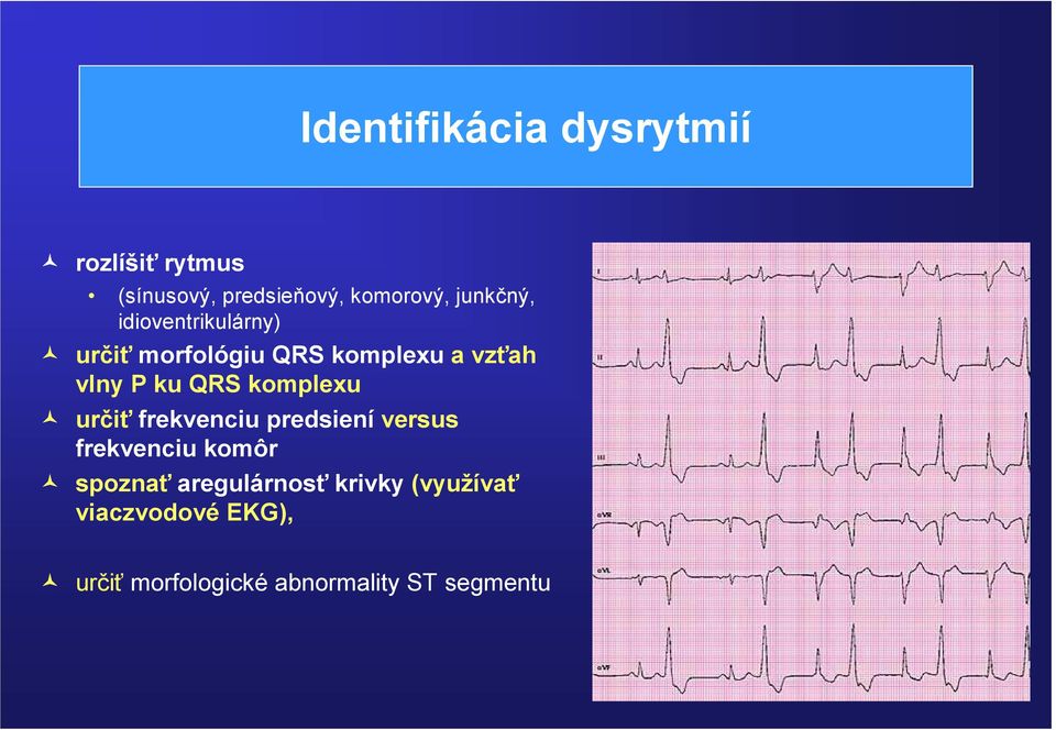 QRS komplexu určiť frekvenciu predsiení versus frekvenciu komôr spoznať