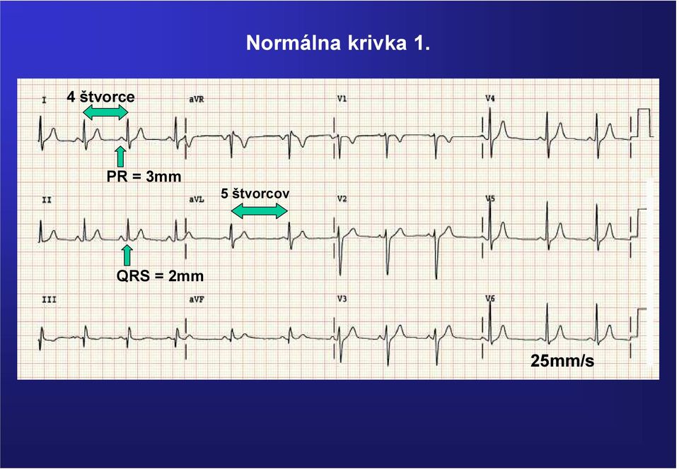 štvorcov QRS = 2mm Rytmus,