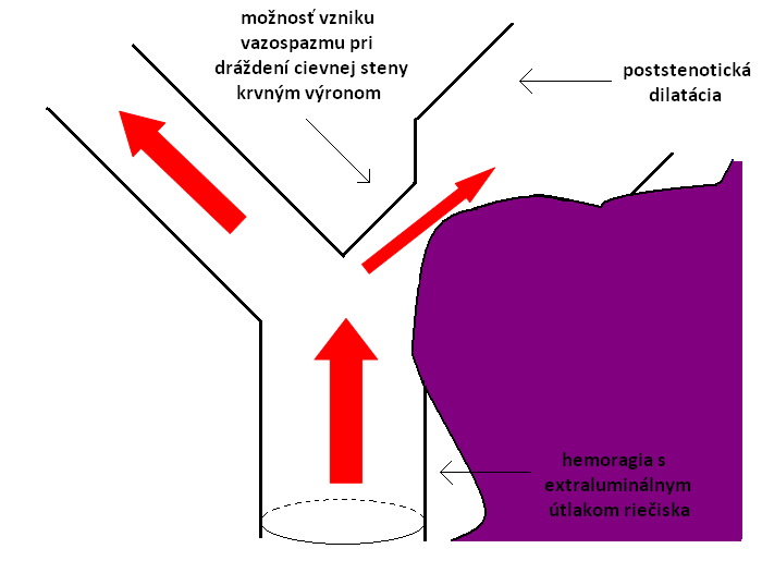 Obr.2 Pri hemorágii je situácia etiologicky a patomorfologicky iná, ale hemodynamické dôsledky sú obdobné.