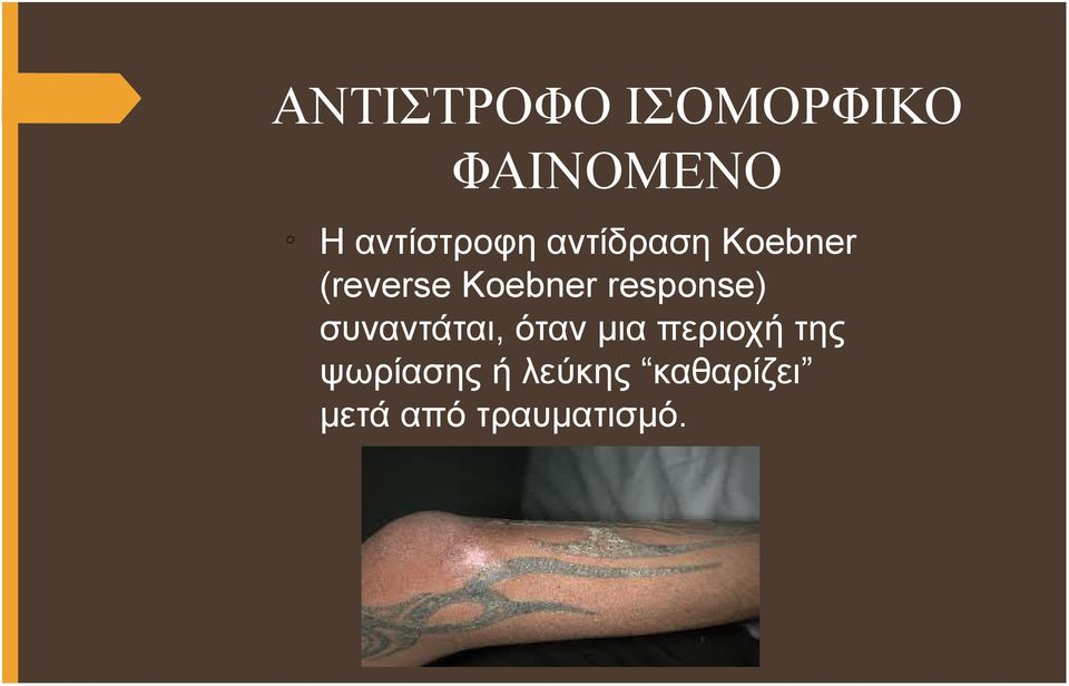 Koebner response) συναντάται, όταν μια