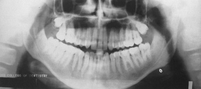 Λανθασμένη θέση - πρόσθια τοποθέτηση δοντιών (From Haring J, Jansen L: