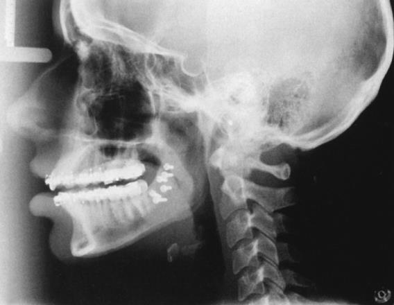 Πλάγια κεφαλομετρική λήψη (From Haring J, Jansen L: Dental radiography: principles and techniques, ed 2,