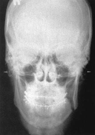 ΟΠ κρανίου (From Haring J, Jansen L: Dental radiography: principles and