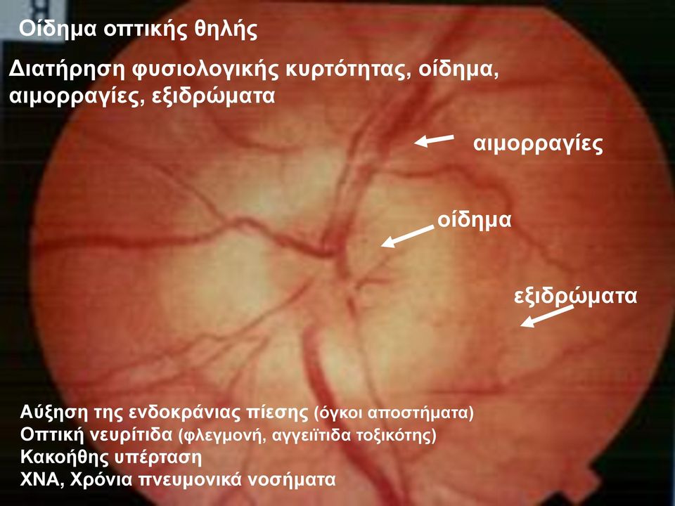 ενδοκράνιας πίεσης (όγκοι αποστήματα) Οπτική νευρίτιδα (φλεγμονή,
