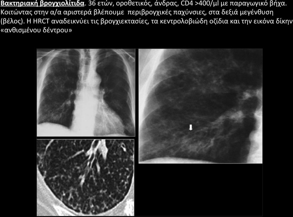 Κοιτώντας στην α/α αριστερά βλέπουμε περιβρογχικές παχύνσιες, στα