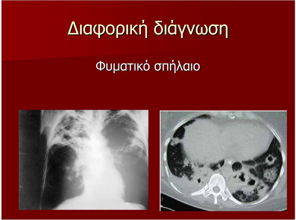 Φυµατικό