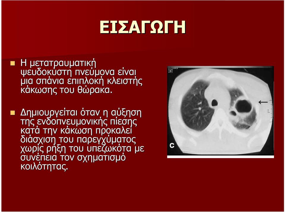 ηµιουργείται όταν η αύξηση της ενδοπνευµονικής πίεσης κατά την