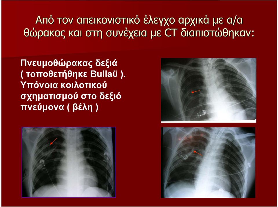 Πνευµοθώρακας δεξιά ( τοποθετήθηκε Bullaϋ ).