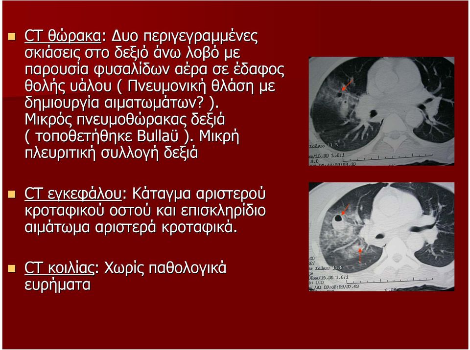 Μικρός πνευµοθώρακας δεξιά ( τοποθετήθηκε Bullaϋ ).