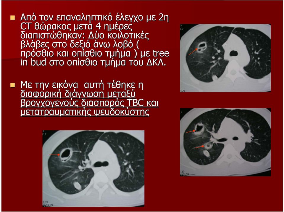 tree in bud στο οπίσθιο τµήµα του ΚΛ.