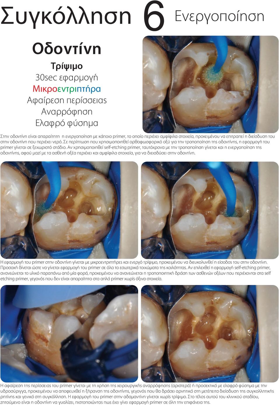 Σε περίπτωση που χρησιµοποιηθεί ορθοφωσφορικό οξύ για την τροποποίηση της οδοντίνης, η εφαρµογή του primer γίνεται σε ξεχωριστό στάδιο.