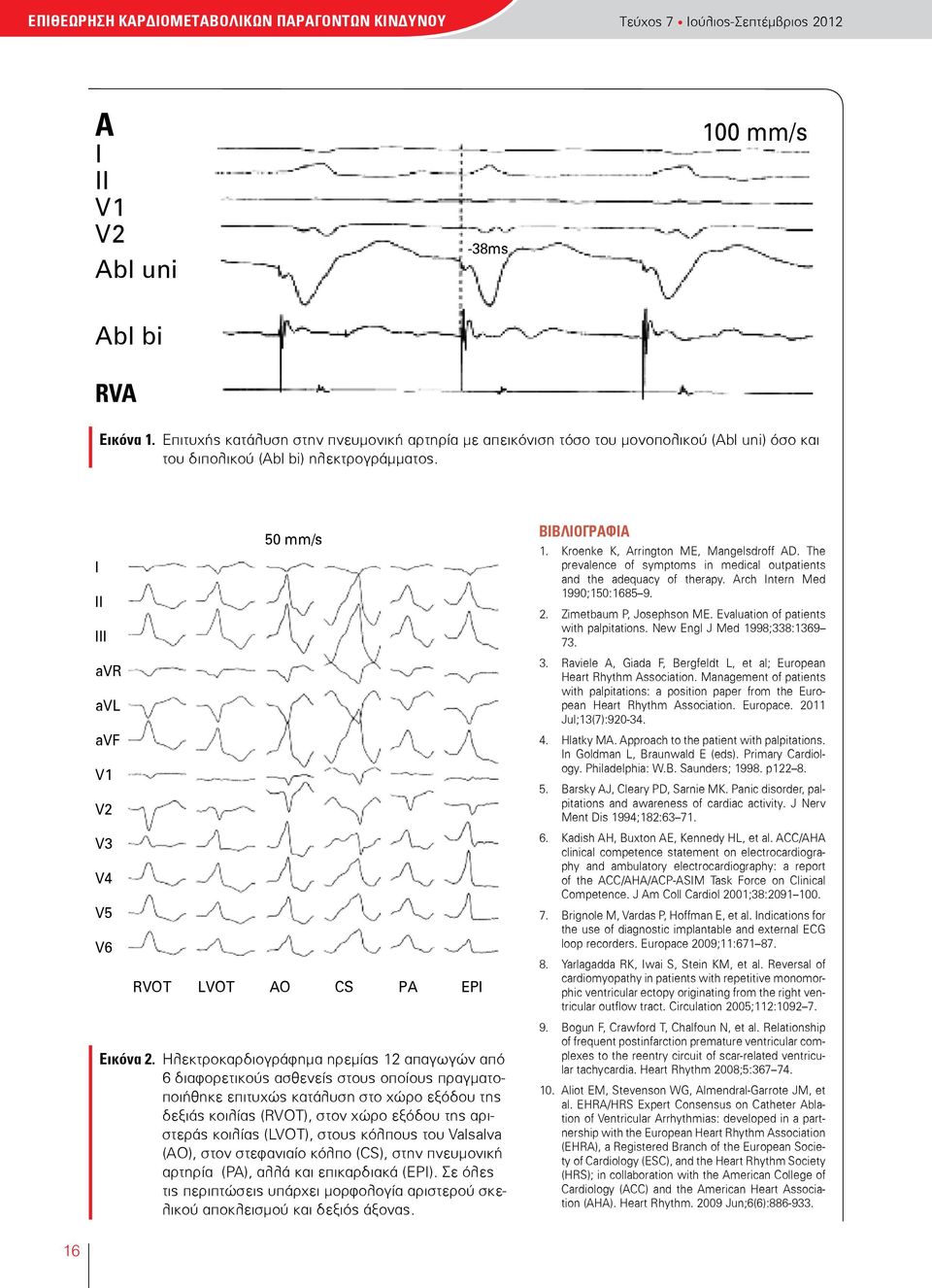 I II III avr avl avf V1 V2 V3 V4 V5 V6 50 mm/s RVOT LVOT AO CS PA EPI Εικόνα 2.