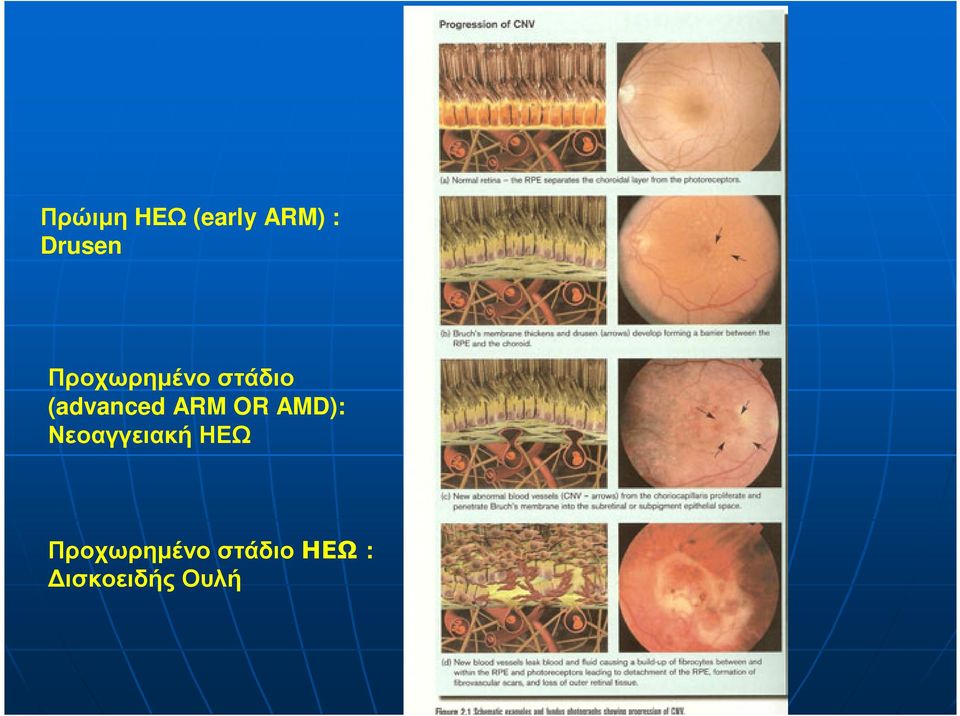 ARM OR AMD): Νεοαγγειακή ΗΕΩ