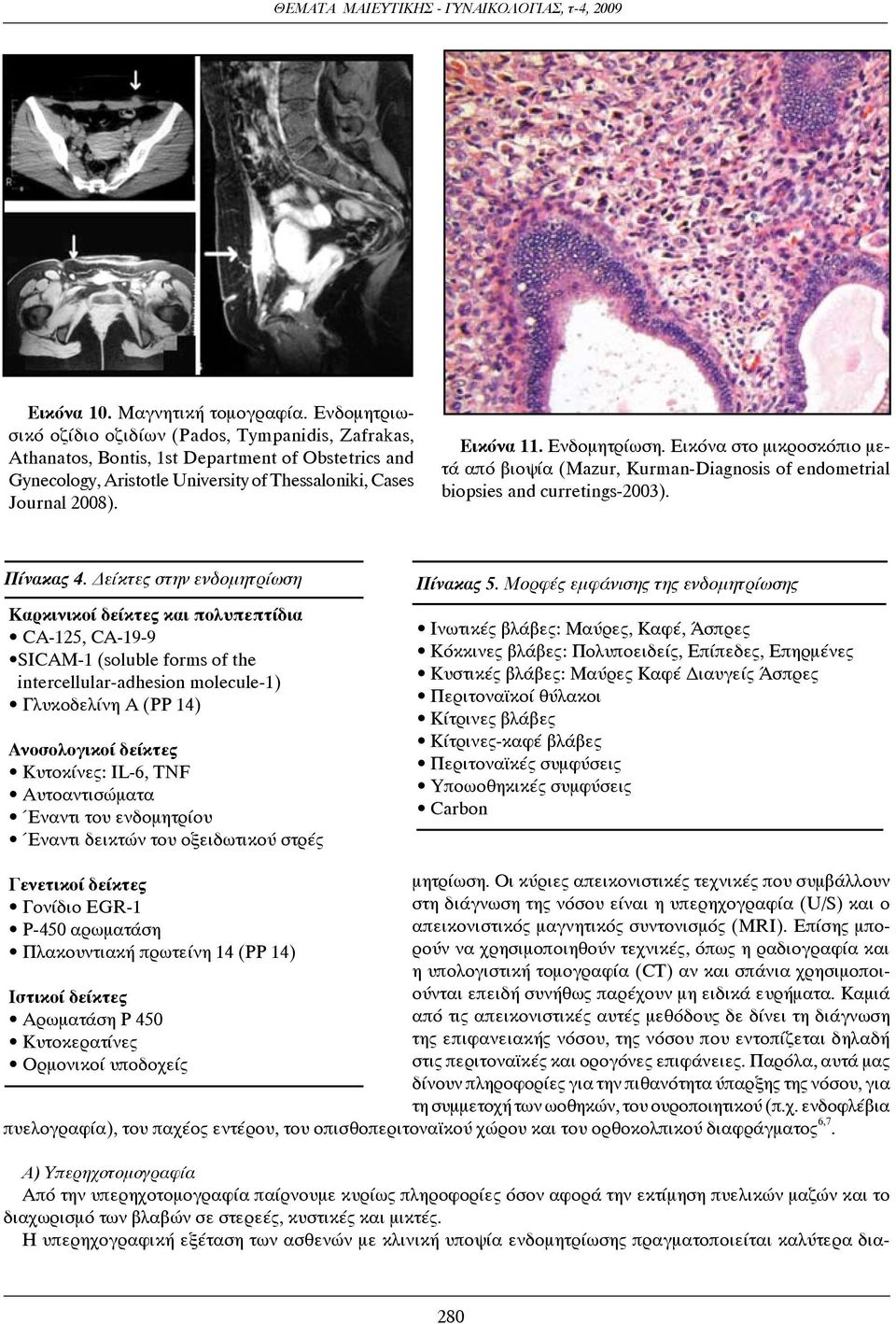 Ενδομητρίωση. Εικόνα στο μικροσκόπιο μετά από βιοψία (Mazur, Kurman-Diagnosis of endometrial biopsies and curretings-2003). Πίνακας 4.