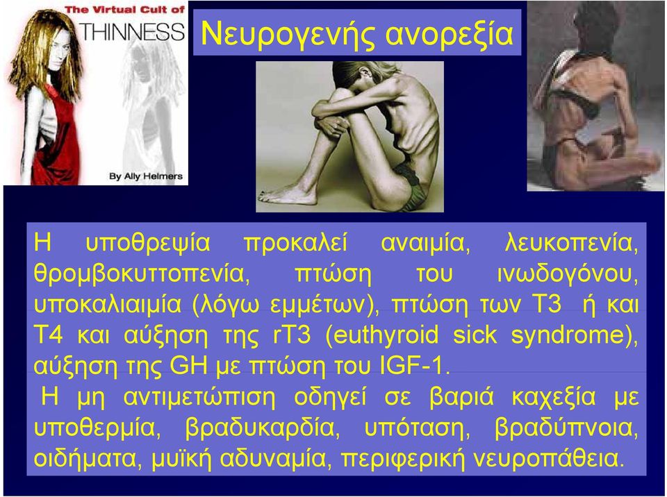 sick syndrome), αύξηση της GH με πτώση του IGF-1.