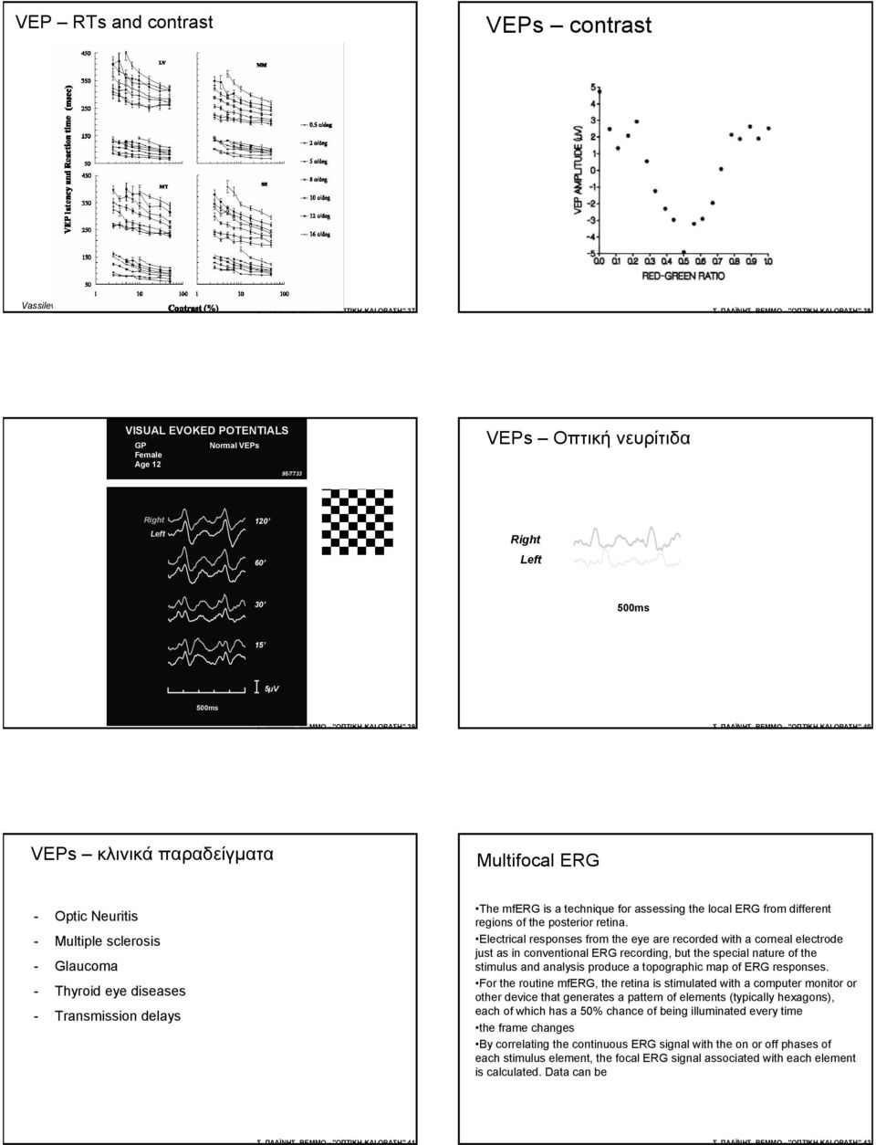 ΠΛΑΪΝΗΣ, ΒΕΜΜΟ "ΟΠΤΙΚΗ ΚΑΙ ΟΡΑΣΗ" 40 VEP κλινικά παραδείγµατα Multifocal ERG Optic Neuriti Multiple cleroi Glaucoma Thyroid eye dieae Tranmiion delay The mferg i a technique for aeing the local ERG