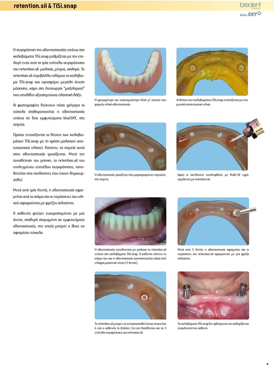 Οι φωτογραφίες δείχνουν πόσο γρήγορα κι εύκολα σταθεροποιείται η οδοντοστοιχία επάνω σε δύο εμφυτεύματα bluesky, στο ιατρείο. Πρώτα εντοπίζονται οι θέσεις των κολοβωμάτων TiSi.