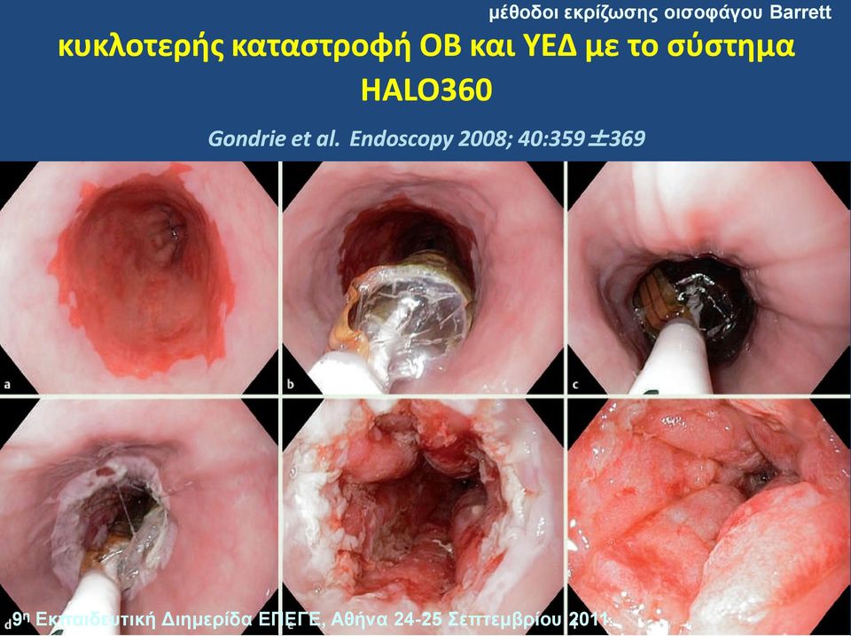 Endoscopy 2008; 40:359±369369 κέζνδνη εθξίδσζεο