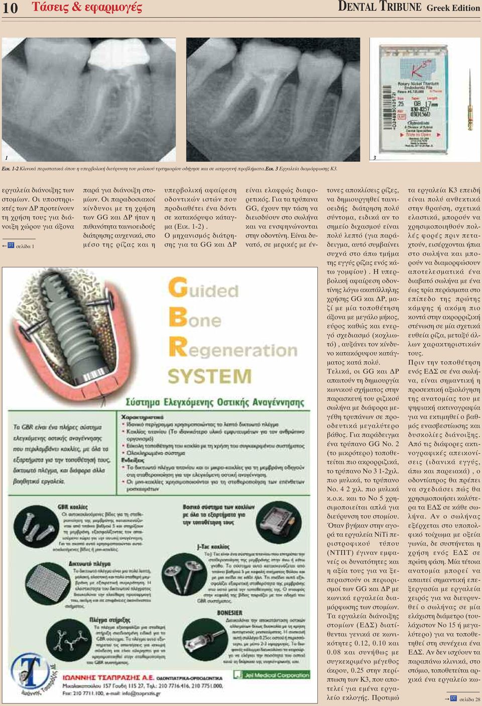 Οι παραδοσιακοί κίνδυνοι µε τη χρήση των GG και Ρ ήταν η πιθανότητα ταινιοειδούς διάτρησης αυχενικά, στο µέσο της ρίζας και η υπερβολική αφαίρεση οδοντικών ιστών που προδιαθέτει ένα δόντι σε