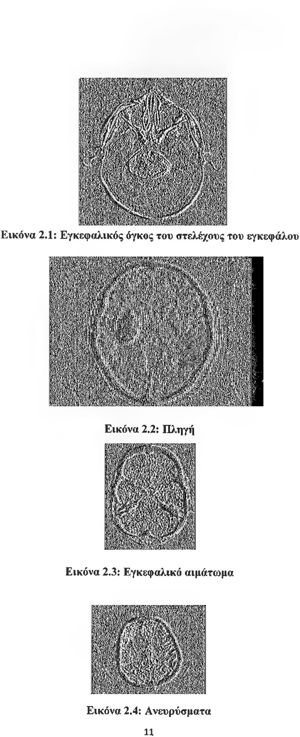 στελέχους του εγκεφάλου 2: Πληγή