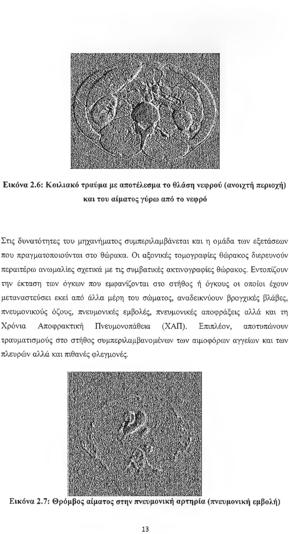 στο θώρακα. Οι αξονικές τομογραφίες θώρακος διερευνούν περαιτέρω ανωμαλίες σχετικά με τις συμβατικές ακτινογραφίες θώρακος.