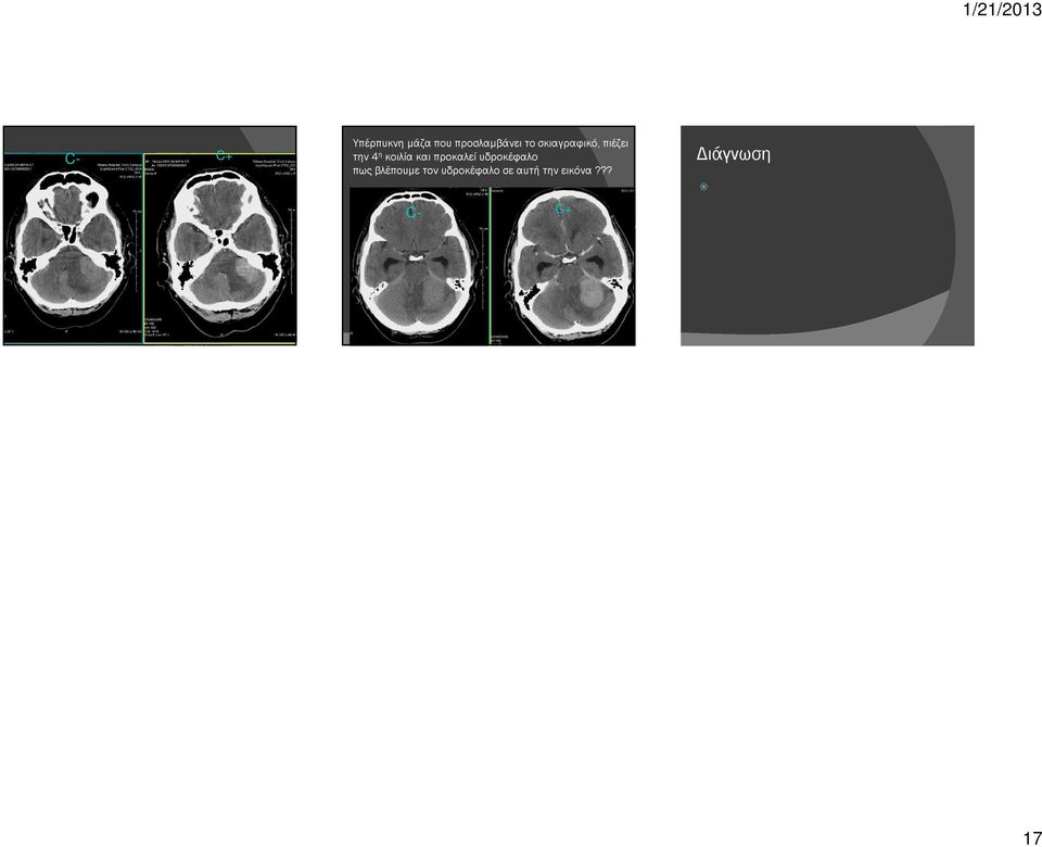 ?? C- C+ Διάγνωση ( ) CΤ εγκεφάλου σε ασθενή με υπερνέφρωμα?? : http://emedicine.