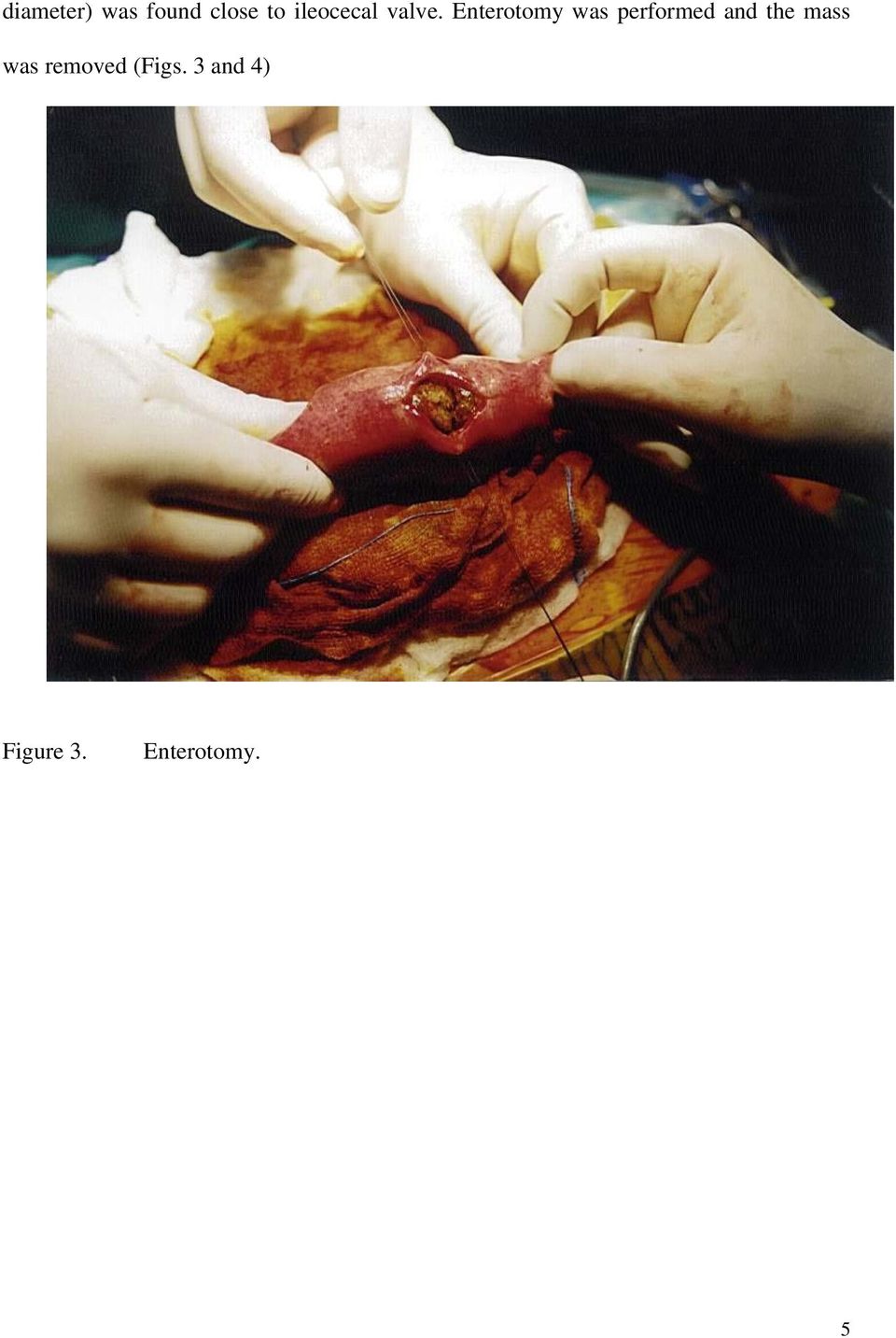 Enterotomy was performed and the