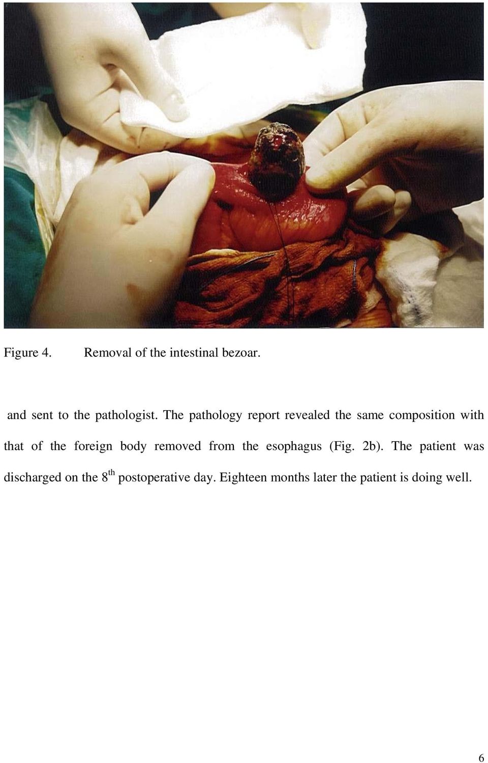 foreign body removed from the esophagus (Fig. 2b).