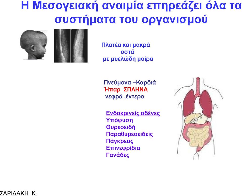 Πλεύκνλα Καξδηά Ήπαξ ΠΛΗΝΑ λεθξά,έληεξν Δλδνθξηλείο